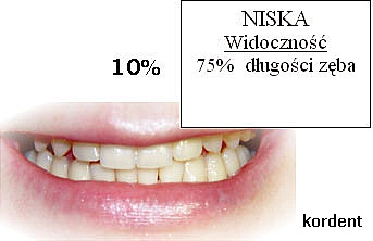 Niska widoczność - 75% długości zęba
