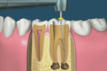 Leczenie kanałowe zęba w klinice Kordent