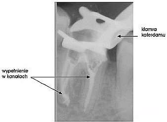 Zdjęcie RTG leczenia kanałowego zęba