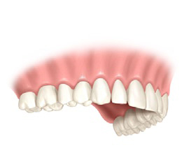 Brak zęba implant