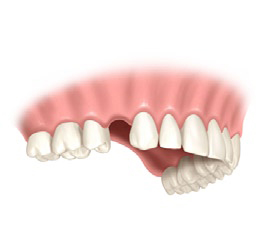 Brak jednego zęba uzupełnienie zęba odbudowa zęba warszawa