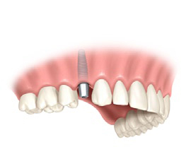 Brak zęba - kolejny etap uzupełnienia implantem