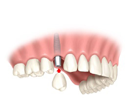 Brak zęba uzupełnienie implantem