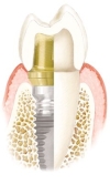 Implant zęba (widok w przekroju)