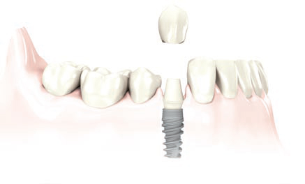 Implant zęba w miejsce brakującego zęba