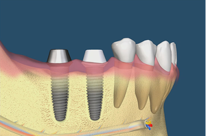 Odbudowa zębów na implantach