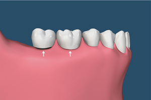 Odbudowa zębów na implantach