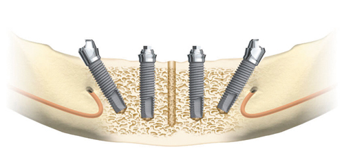 Implanty zębów ALL-ON-4 - wszystkie zęby na czterech implantach