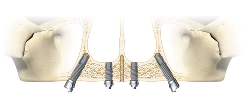 Implanty zębów ALL-ON-4 - wszystkie zęby na czterech implantach