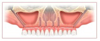 zygoma implanty zębów