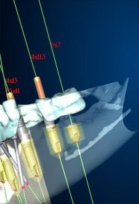 Nobel Guide zabieg implantacji zębów