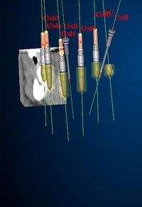 Nobel Guide Zęby w 24h - zabieg implantów