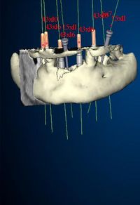 Nobel Guide Biocare implanty zębów