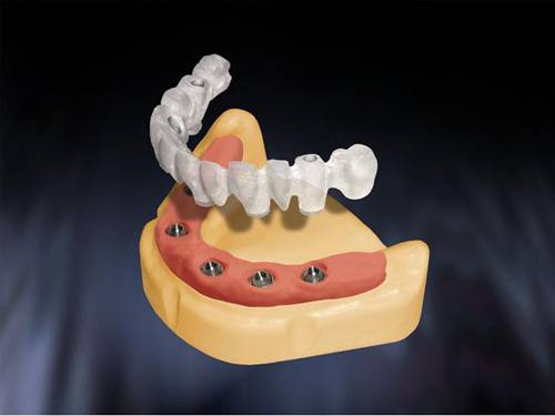 implant procera most zębowy