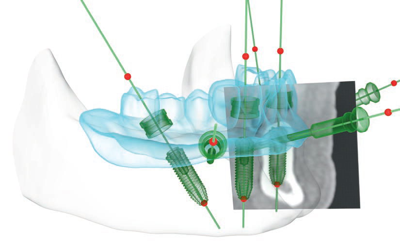 Nobel Guide uzupełnienia zębów implantami w Warszawie