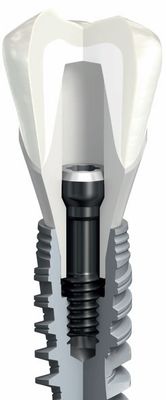 Budowa implanta zęba: korona implant łącznik