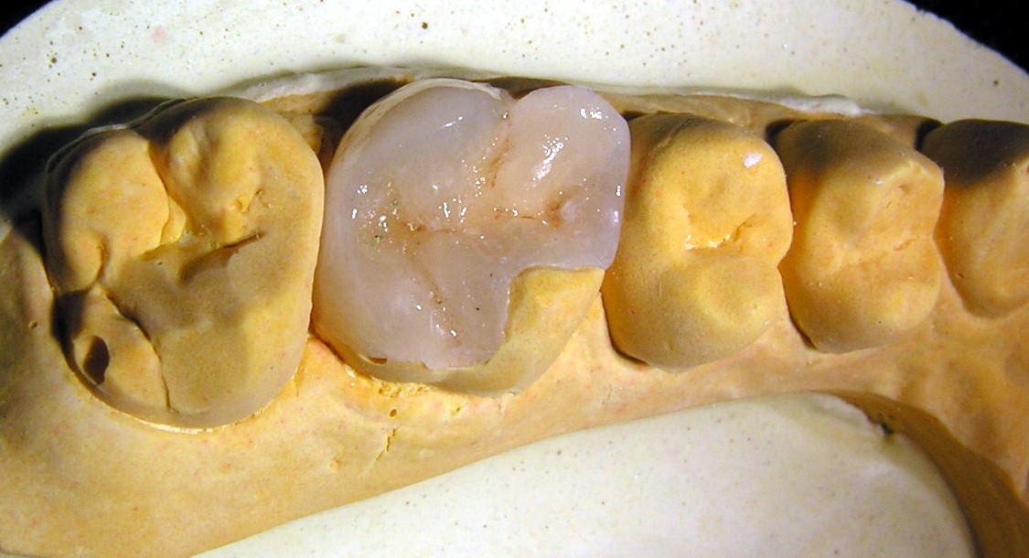 korona zęba warszawa