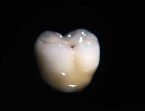 trzonowiec - Korona zęba korzeniowa w klinice stomatologicznej Kordent w Warszawie
